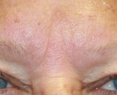 Feel Beautiful - Gel Filler (Restylane Fine Line) into brow creases - Before Photo